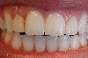 Closeup of perfectly aligned teeth