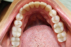 Teeth after crowding is corrected
