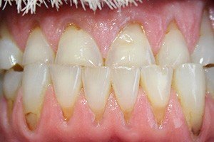Teeth with dark staining and gum recession