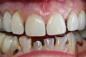 Damaged and decayed teeth