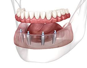 Illustration of All-on-4 in Chesterfield, MO in lower jaw