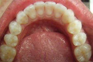 Bottom teeth after alignment