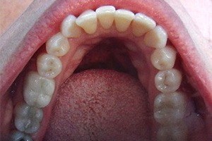 Overlapping bottom teeth