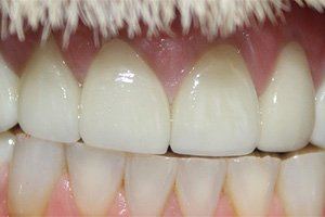 Flawlessly repaired teeth and gums