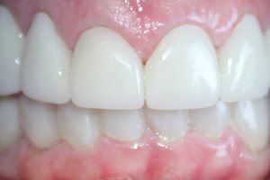 Flawlessly repaired teeth and gums