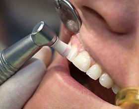 person getting teeth polished during teeth cleaning visit