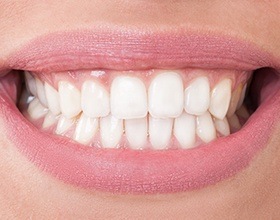 Closeup of flawless smile after porcelain veneer treatment