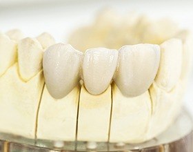 Model of dental crown supported fixed bridge