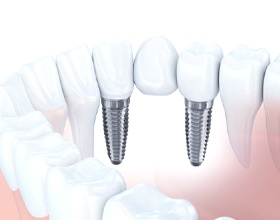 Diagram of an implant dental bridge in Chesterfield