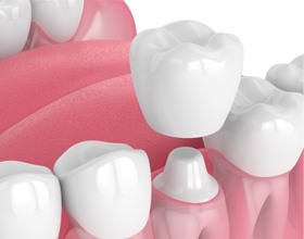 Diagram showing how dental crowns in Chesterfield work