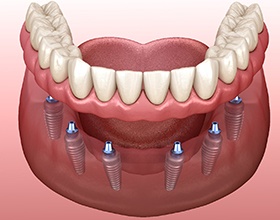 3D rendering of implant dentures