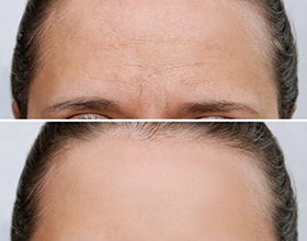 A woman’s forehead before and after Dysport