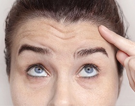 A woman before and after Dysport injections