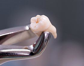 Metal clasp holding extracted tooth