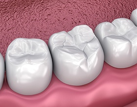 Digital model of a tooth-colored filling
