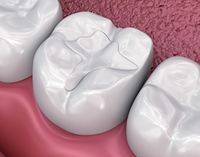 Tooth-colored filling on molar