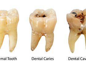 Stages of tooth decay