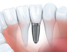 Diagram of dental implants in Chesterfield 