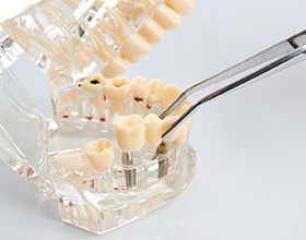 dentist placing implant bridge on model teeth
