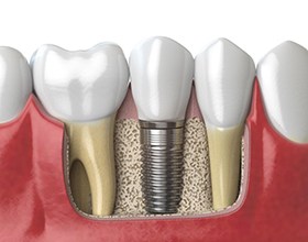 Diagram of dental implants in Chesterfield during osseointegration