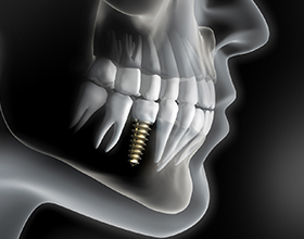 X-ray of a person with a single dental implant