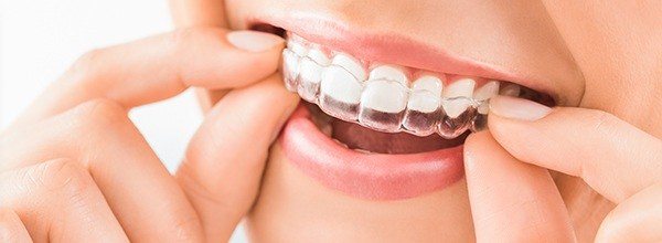 Invisalign special coupon