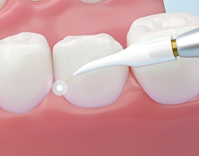 Illustration of laser periodontal treatment 