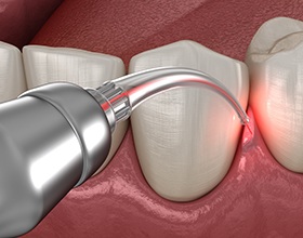 Illustration of teeth, gums, and soft-tissue laser