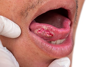Patch of cancerous tissue on man’s tongue