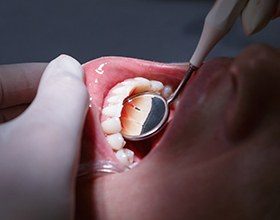 Closeup of healthy teeth and gums after periodontal therapy