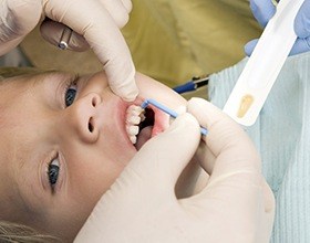 Child receiving fluoride treatments