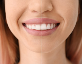 A woman before and after gum recontouring