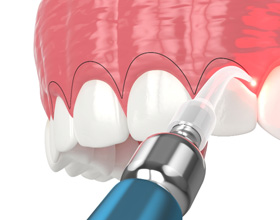 A CGI of gum recontouring