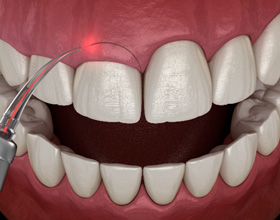 A CGI of a gum recontouring procedure