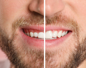 A man before and after gum recontouring