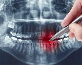 X-ray of problem tooth before root canal therapy