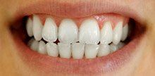 Brilliant white smile after teeth whitening