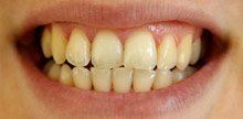 Yellowed teeth before teeth whitening