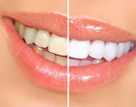 Before and after teeth whitening