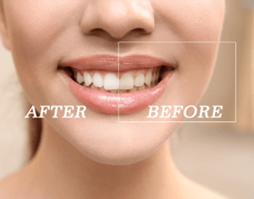 Woman's smile before and after teeth whitening treatment