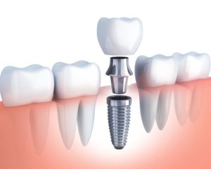 Diagram from your Chesterfield dentist showing parts of a dental implant