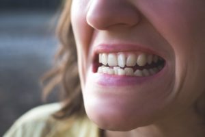 woman with crooked teeth needs Invisalign in Chesterfield