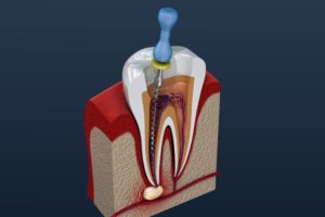 Digital image of a root canal in Chesterfield. 