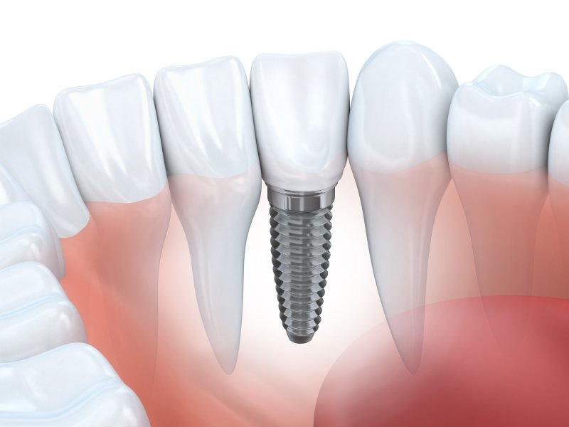 Illustration of restored dental implant in lower arch