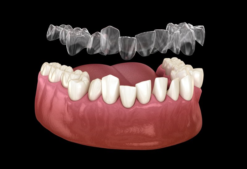 A 3D illustration of Invisalign trays fixing a patient’s bite problems