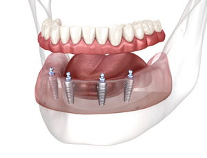 Illustration of All-on-4 implants and dentures