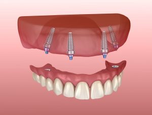 Implant-supported upper denture