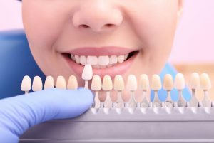 Nose to chin view of a woman smiling while a dentist holds a shade guide to her teeth