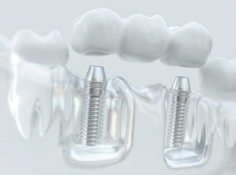 An example of titanium dental implants