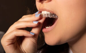 Close up of woman inserting clear aligner